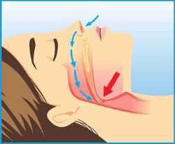 diagram of closed airway