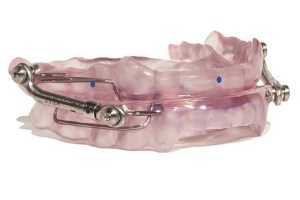 Herbst oral appliance