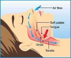 open airway